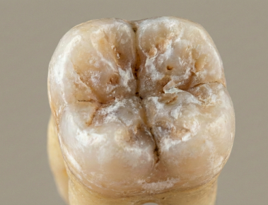 Терапевтическое лечение без боли