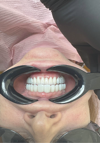 Можно ли удалять зуб рядом с имплантом